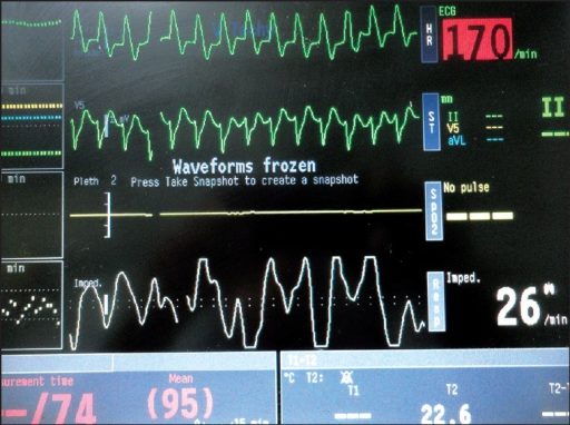 Ventricular Tachycardia Monitor