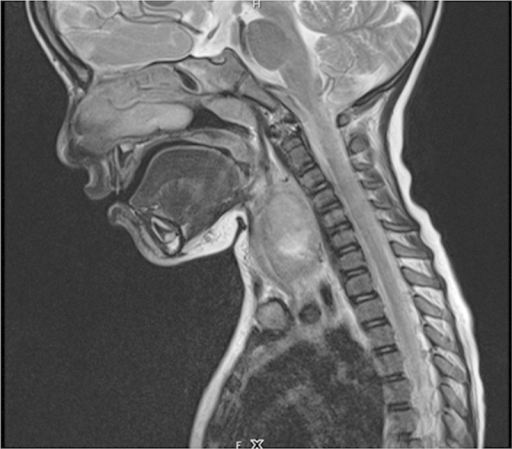 MRI Showing A Neck Abscess. | Open-i