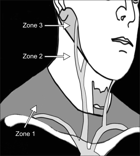 Neck injury. Reina cor Zones 1.