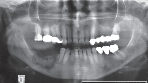 Osteolytic Lesion In The Lower Jaw Of Patient Treated W My Xxx Hot Girl 2992