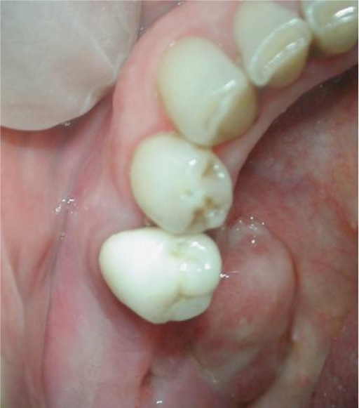 Advanced lesion of the upper jaw in patient treated wit | Open-i