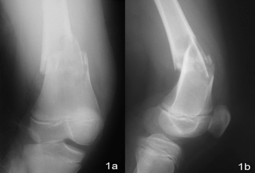 comminuted open fracture pictures