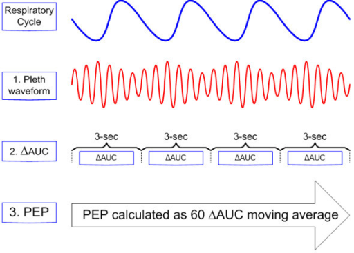 Pulsus Paradoxus Arterial Waveform