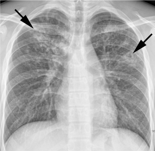 pneumonia cxr findings