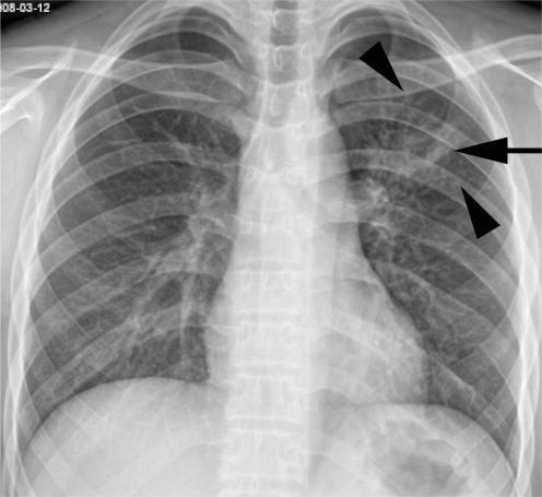 Pulmonary tuberculosis in 18-year-old boy with typical | Open-i