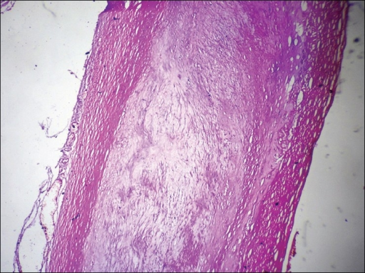 Microphotograph of aorta showing well formed atheromato | Open-i