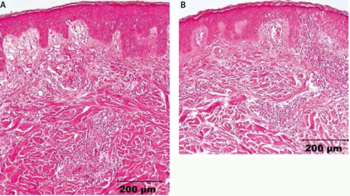 Histopathology Skin Punch Biopsy Severe Edema Of The Open I