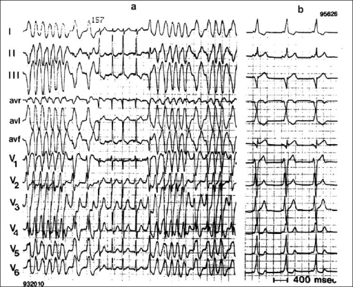 Wpw Afib Syndrome Ekg Parkinson Wolff White Wikidoc Fibrillation Atrial ...