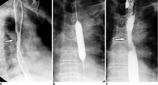 radiation induced esophageal stricture a esophagogram gastric outlet obstruction