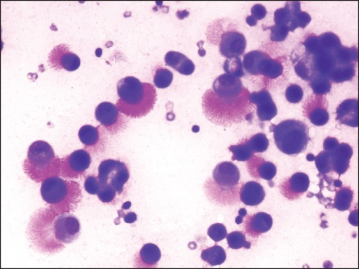 Smear from ascitic fluid showing scattered tumor cells | Open-i