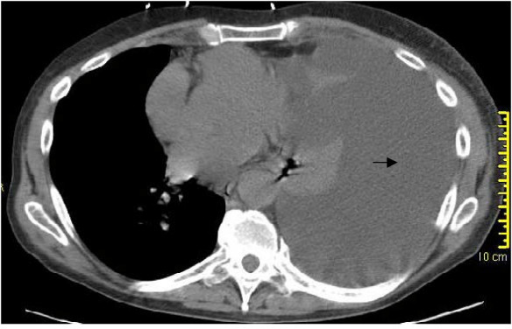 CT chest: massive pleural effusion on left side (arrow) | Open-i