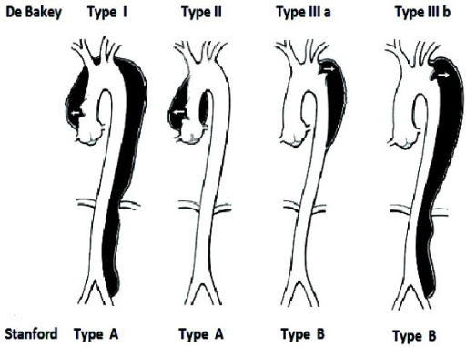 Classification des dissections aortiques selon De Bakey | Open-i