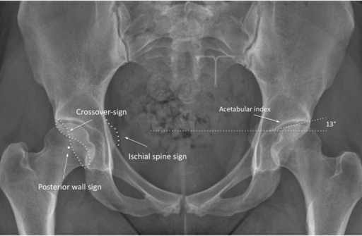 Ischial Spine Sign