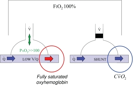 Effect of supplemental oxygen on ventilation-perfusion Effect of supplemental oxygen on ventilation-perfusion