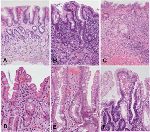 Correa's precancerous cascade. A, Normal gastric mucosa | Open-i