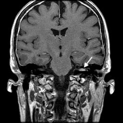 รายการ 93+ ภาพ ภาพ Mri สมอง อัปเดต