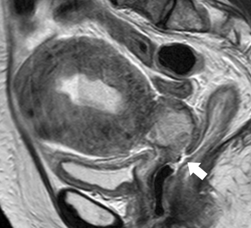 Cervical cancer and rectovaginal fistulation. Sagittal | Open-i