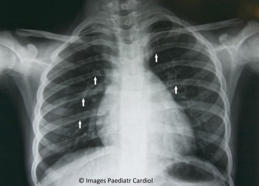 CXR demonstrating rib notching in coarctation of the ao | Open-i