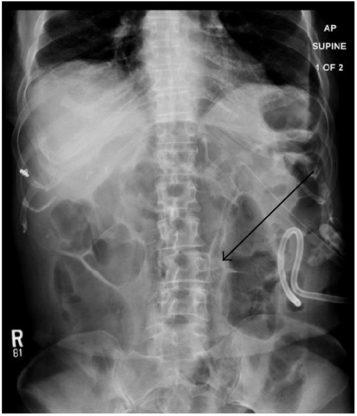 abdominal-radiograph-demonstrates-gastrostomy-tube-and-open-i