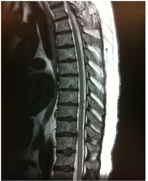 Mri Thoracic Spine Showing Acute Spinal Cord Infarction