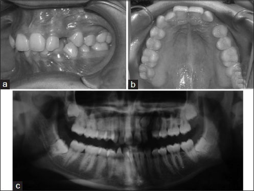 Clinical photographs of orthodontic treatment from pretreatment to