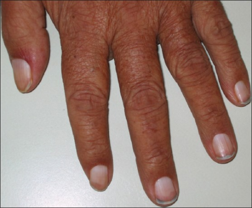covid 19: Observing changes in fingernails? Red half-moon-shaped marks,  ridges and white lines may be due to Covid - The Economic Times