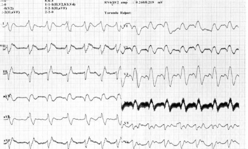 Ecg Shows Widened Qrs And Prolonged Pr Interval Open I