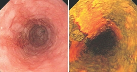 cancer squamous cell oesophageal open policy copyright esophageal