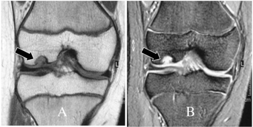 (A) T1-weighted Coronal MR Image (B) T2-weighted Corona | Open-i