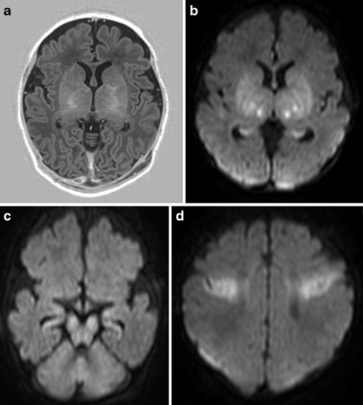 Full-term infant with acute sentinel event (ruptured ut | Open-i