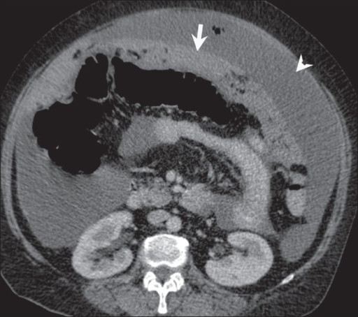 Peritoneal carcinomatosis. Omental caking (arrow) and a | Open-i