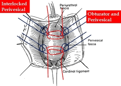 Diagram Of CRISP Cystocele Repair Using Interlocking S Open I