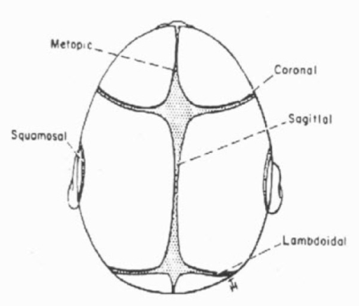 Cranial sutures in infancy. Premature closure of any of | Open-i