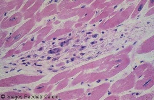 Myocardial Aschoff body – the cells are large, elonga | Open-i