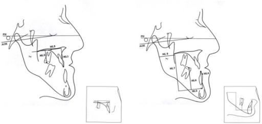 Axis Orbital Marker Lines System (AO-MLS). The referenc | Open-i