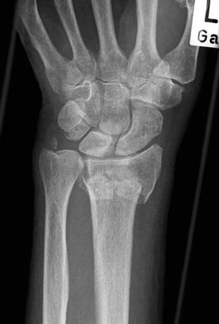 Intraarticular distal radius fracture. Anteroposterior | Open-i