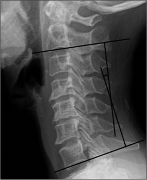 Cobb's method for measuring cervical lordosis. Cervical | Open-i