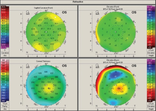 Four map composite display (sagittal curvature, anterio | Open-i