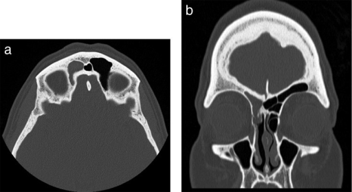 Preoperative Computed Tomography (CT) Scans For Patient | Open-i