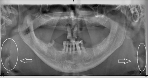 A Panoramic Radiograph Of A 76 Year Old Female There W Open I 6785