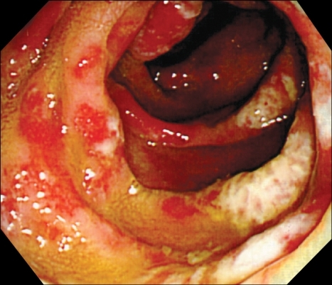 Sessile polyps with exudates and hyperemia in the sigmo 