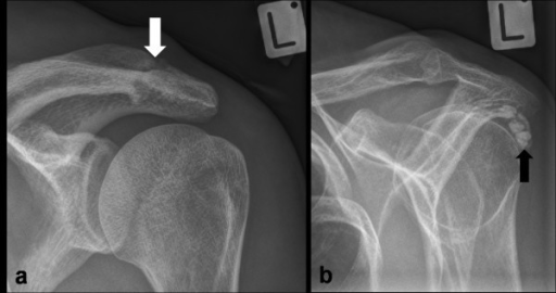 Shoulder x-ray images of ACJ pathology and rotator cuff | Open-i