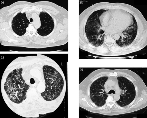 Exacerbation of idiopathic pulmonary fibrosis (IPF) due | Open-i