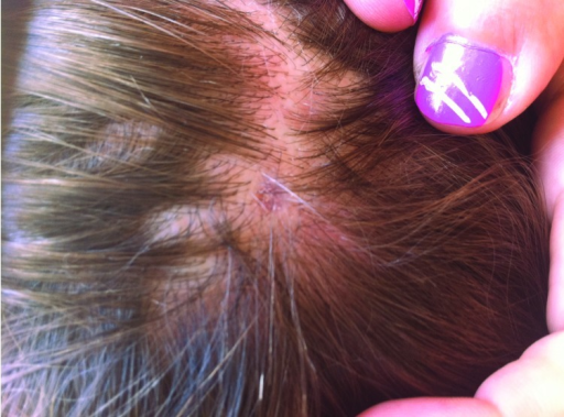 Icd 10 Code For Tick Bite On Scalp   PMC3647502 12 1169 F 