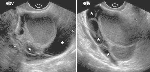 Transvaginal ultrasound images showing typical features | Open-i