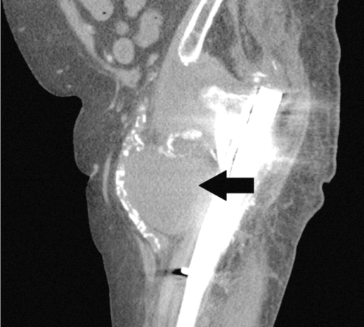 CT scan of the hip. CT scan without contrast medium of | Open-i