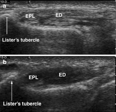 Transverse Ultrasound Of The Extensor Surface Of The Wr 