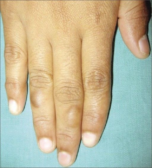 Calluses on the dorsum of middle and ring finger | Open-i