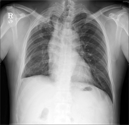 Preoperative chest radiograph shows apical thickening a | Open-i