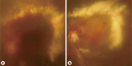 A Massive Subretinal Hemorrhage Including The Macula Developed 7 Days After Second PDT A Massive Subretinal Hemorrhage Including The Macula Developed 7 Days After Second PDT